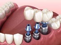 Как подготовиться к имплантации зубов? Советы стоматологов