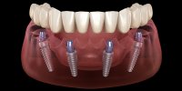 Имплантация зубов по технологии All‐on‐4